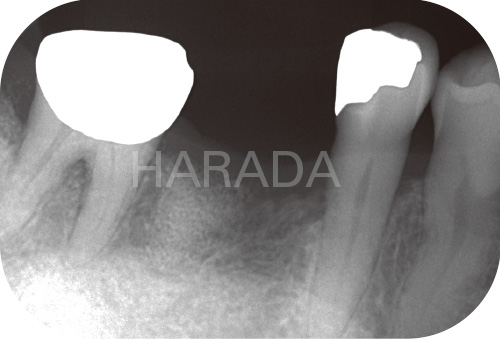[写真] 約1年後に第一大臼歯部位のインプラント埋入と同時にリエントリーして骨の再生状態を確認した