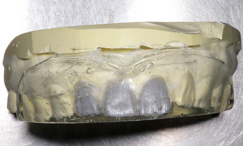 残る3本はワックスアップを用いて最終的な歯冠形態を具現化