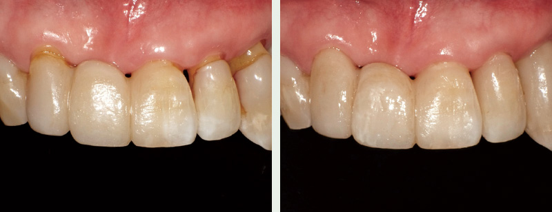 2010年に行った前歯部修復は経年劣化がみられ、マージン部分の着色も見られるようになったので、2022年に前歯部の旧修復材料を削除し、MIの原則にのっとった修復を目指すべく、ここでは「クリアフィル® マジェスティ® ES フロー Universal」で充填を行った