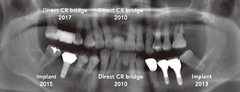 上下前歯部をまずブリッジに、その後インプラントが入り、さら臼歯部にCRダイレクトブリッジ修復を行い、残存歯数は1本減となった
