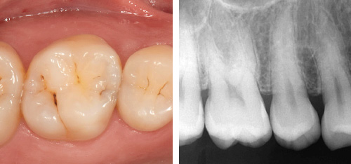 左：術前口腔内写真 / 右：術前デンタルX線写真
