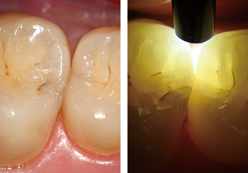 左：マイクロスコープで拡大視野下に確認 / 右：「マイクロラックスⅡ」（アドデント）にて透照診を行うと、両隣接歯の辺縁隆線にクラックを認める