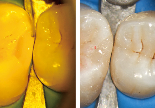 左：アイボリー型セパレーターにて歯間を離開した状態で、窩洞の小さな5から充填した後、6を充填する / 右：充填直後の咬合面観
