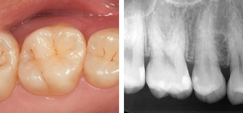 左：術後口腔内写真 / 右：術後デンタルX 線写真