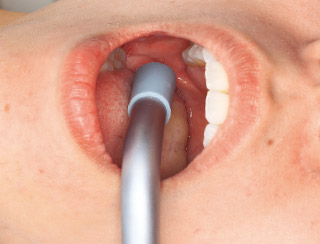 患者さんの左口角にバキュームチップのAを軽くあてる写真